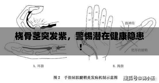 桡骨茎突发紫,警惕潜在健康隐患!