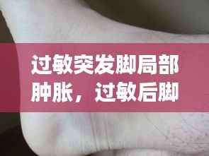 过敏突发脚局部肿胀,过敏后脚浮肿怎么办